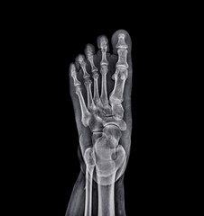 Foot x-ray image  isolated on black background.