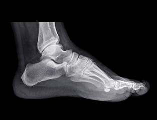 Foot x-ray image on isolated on black background.