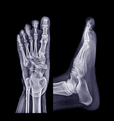 Foot x-ray image AP and Lateral view  isolated on black background.