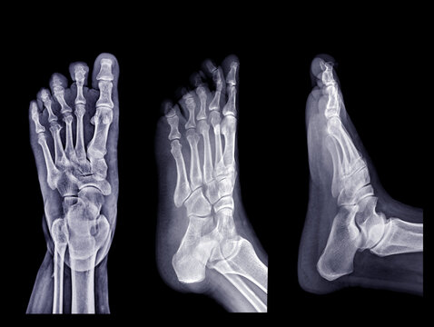 Collection of Foot x-ray image  isolated on black background.