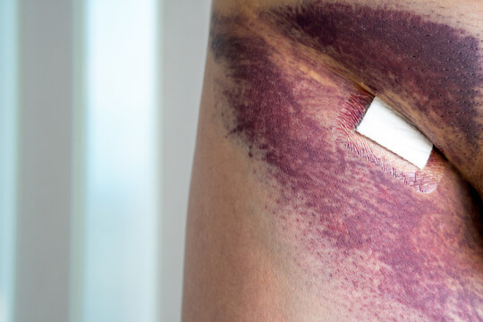 Bruise On Leg Images – Browse 7,681 Stock Photos, Vectors, and Video |  Adobe Stock