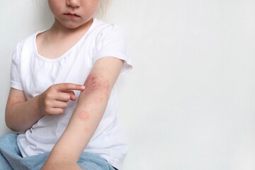 The child scratches atopic skin. The child applies a special cream to atopic skin. Dermatitis, diathesis, allergy on the child's body.	