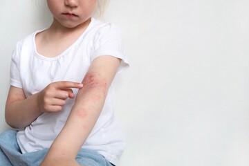 The child scratches atopic skin. The child applies a special cream to atopic skin. Dermatitis,...