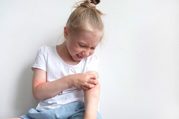 The child scratches atopic skin. The child applies a special cream to atopic skin. Dermatitis,...