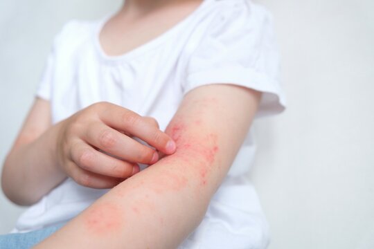 The child scratches atopic skin. The child applies a special cream to atopic skin. Dermatitis, diathesis, allergy on the child's body.	