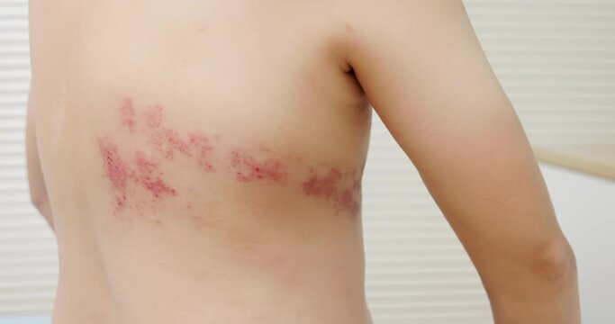 man with shingles disease