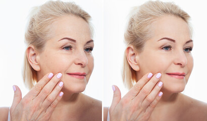 Middle age close up woman face before after cosmetic procedures. Skin care for wrinkled face....
