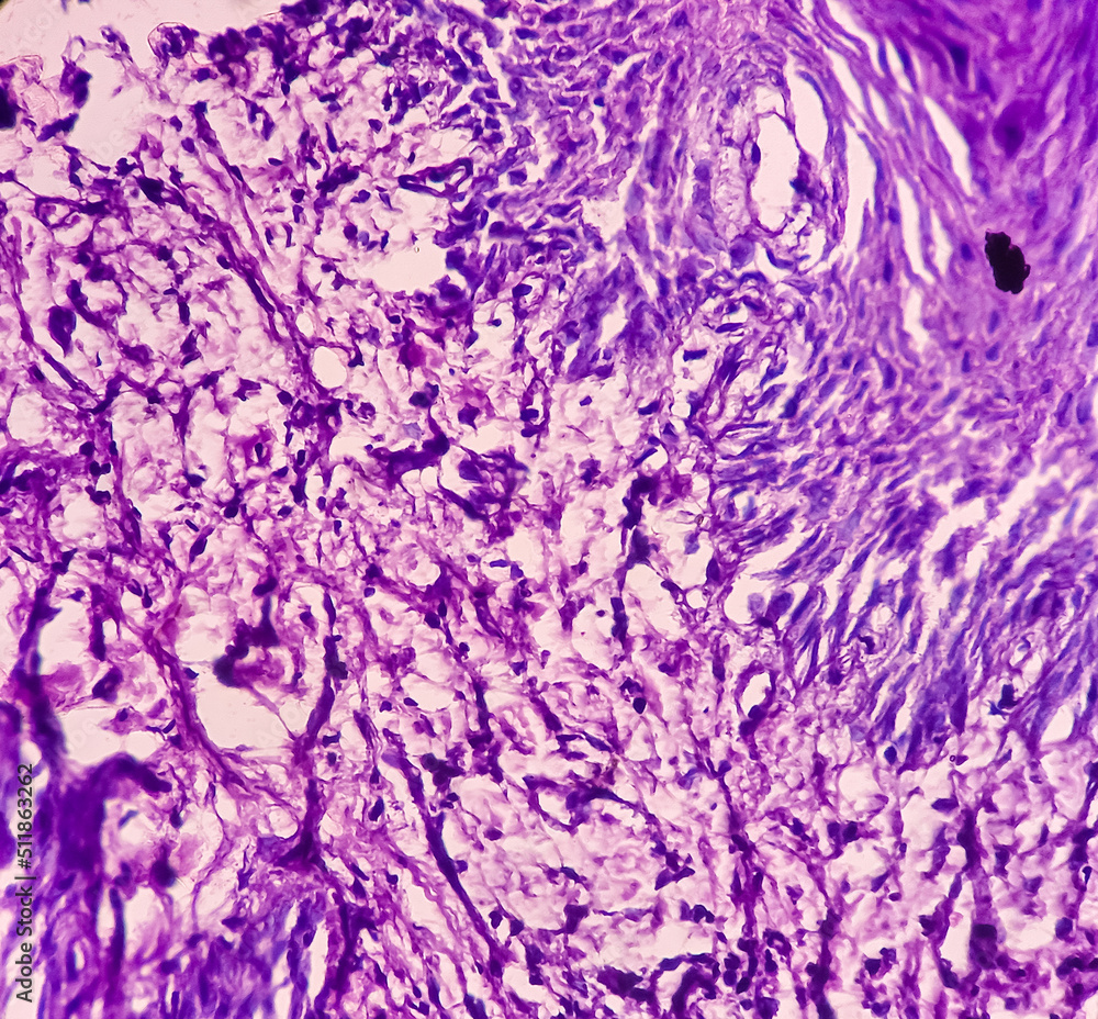 Poster Photomicrograph of chronic osteomyelitis from maxillary region tissue, image show bony tissue, dead bone, polymorphs, lymphocytes, histiocytes.