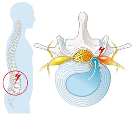 Herniated disc of the lumbar spine, stenosis, slipped disc, labeled illustration