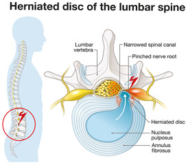 Herniated disc of the lumbar spine, stenosis, slipped disc, labeled illustration