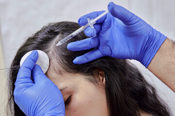 treatment of hair loss, injection for hair growth. Injected in woman's head, hair mesotherapy