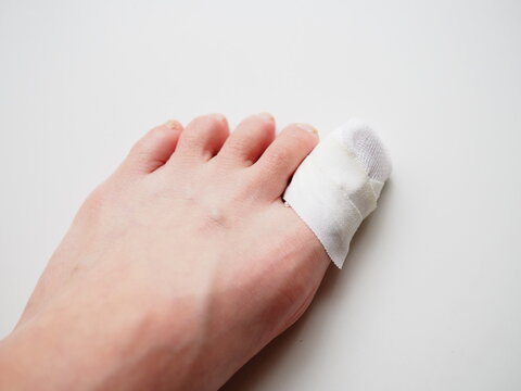 the bandage on the woman's toe. the toenail is damaged and cracked.