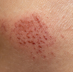 Fototapeta premium scratches on the skin as a background