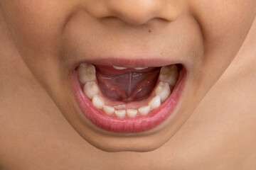 Close up latin boy with two rows of teeth. Shark teeth. Permanent teeth growth