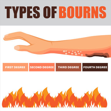 Skin burn injury treatment and stages infographic. damage from fire. Red skin. Isolated vector illustration in cartoon style