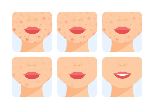 Acne on Chin and Cheeks. Female Part of Face in a Rash. Acne Treatment. Before After. Steps. Healthy Clean Skin and a Happy Smile. Color Cartoon style. White background. Vector image for Beauty design