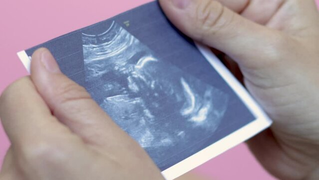 pregnancy and baby waiting. ultrasound picture with fetus in uterus in woman's hand,on pink background.2 different gestation periods.sonogram of fetus, unborn yet baby, flat lay, love care