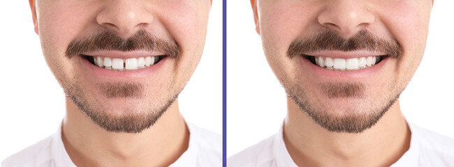 Collage with photos of man with diastema between upper front teeth before and after treatment on...