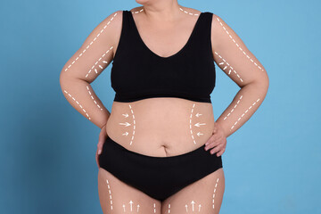 Woman with marks on body before cosmetic surgery operation on light blue background, closeup