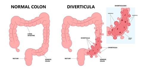 Bowel colon cancer and crohn's disease polyp hernia rectum diverticula ulcer blood stool pain Fecal exam sigmoid diet blocked test C. diff stoma swelling disorder peritonitis rectal