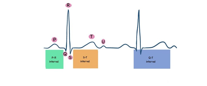 ECG image show normal ECG with waves and intervals 