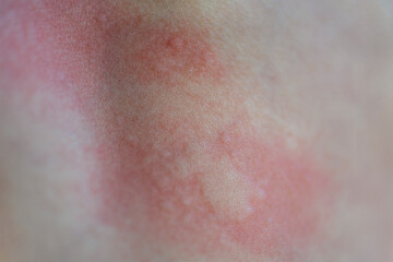 Urticaria on the skin. Red spots of an allergic reaction on the skin of a child. Urticaria symptoms...