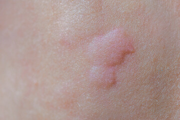 Urticaria on the skin. Red spots of an allergic reaction on the skin of a child. Urticaria symptoms...