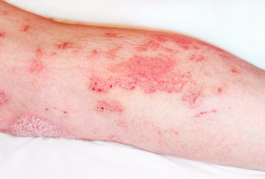 Acute psoriasis, severe reddening of the skin,an autoimmune,incurable dermatological skin disease.Large red,inflamed,scaly rash on man's legs. Joints affected by psoriatic arthritis.