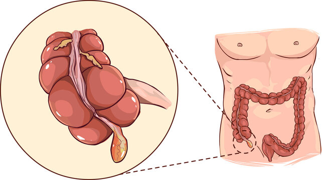  illustration of a with detail of an appendicitis