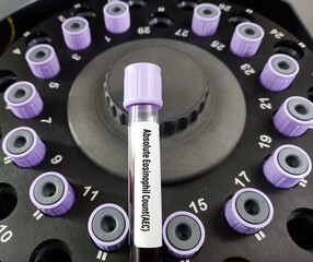 Blood sample for Circulating Eosinophils test at medical laboratory. Diagnosis for allergy