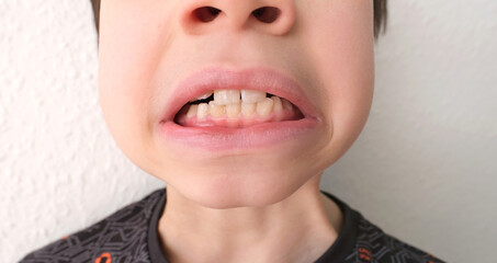 child, kid shows tooth that sways and hurts, the concept of pediatric dentistry, dental treatment...