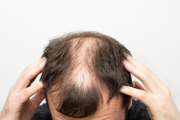 Fototapeta premium Male pattern baldness how to deal with it