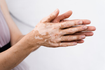 Hands with vitiligo skin pigmentation on white background close-up. Lifestyle with Seasonal skin...