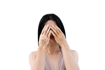Woman with vitiligo pigmentation patches on hands covers her face with her hands on white...
