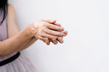 Hands with vitiligo skin pigmentation on white background close-up. Lifestyle with Seasonal skin...