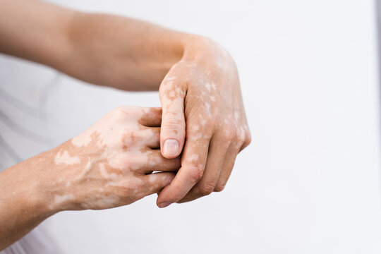 Hands with vitiligo skin pigmentation on white background close-up. Lifestyle with Seasonal skin diseases.