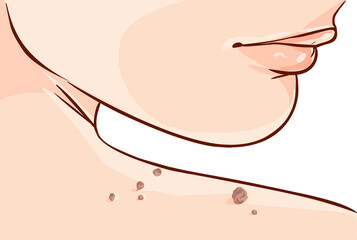 illustration of a Skin Tag Removal Methods
