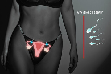 Female sterilization, uterus and female body silhouette, vasectomy - obrazy, fototapety, plakaty