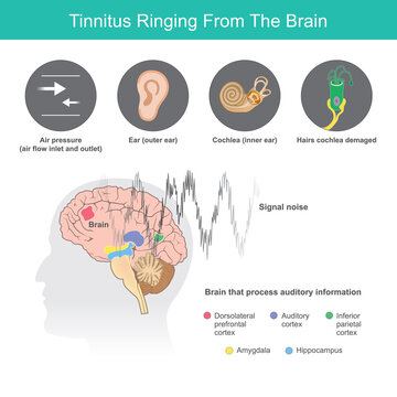 Tinnitus Ringing From The Brain, Is the term for a buzzing noise in your ears from symptoms abnormal in ears or the brain..
