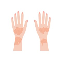 Human hands with psoriasis and rashes. Red eczema eruptions and inflamed eczema. Allergic urticaria problems and infectious vector smallpox infection