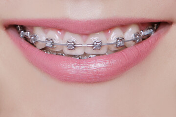 metal braces on young girl's teeth