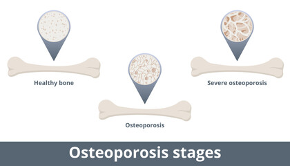 Osteoporosis stages. Disease develops when bone mineral density and bone mass decrease. Visualization includes healthy bone, osteoporosis, and severe osteoporosis.
