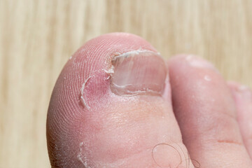 Male foot with athletes foot condition