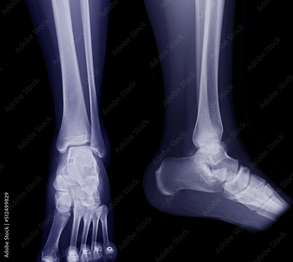 Poster x-ray image of ankle joint ap and lateral view for diagnosis fracture tibia and fibula bone.
