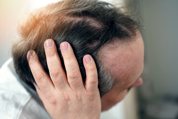 Fototapeta premium Baldness on the head of a middle-aged man. Hair loss.