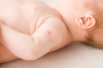 Red point after tuberculosis vaccine on newborn shoulder skin. Baby healthcare concept. Closeup. - obrazy, fototapety, plakaty