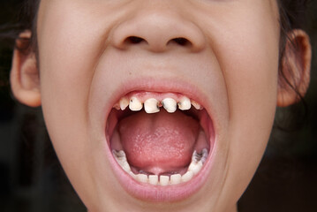 Little Asian girl with open mouth showing damaged teeth with cavity dental caries.
