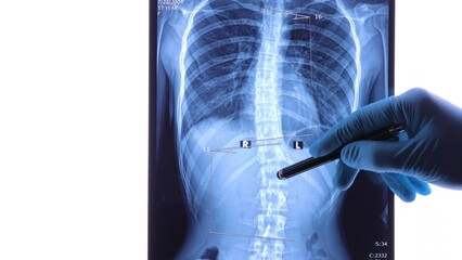 Doctor analyzing X ray of the spine showing scoliosis in the lumbar area. Scoliosis is an abnormal lateral curvature of the spine. Dolly shot 4k
