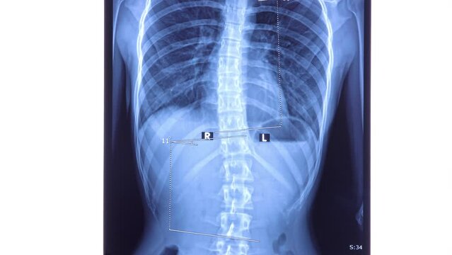 X ray of the spine showing scoliosis in the lumbar area. Scoliosis is an abnormal lateral curvature of the spine. Dolly shot 4k