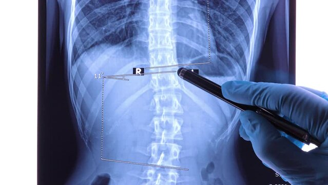 Doctor analyzing X ray of the spine showing scoliosis in the lumbar area. Scoliosis is an abnormal lateral curvature of the spine. Dolly shot 4k